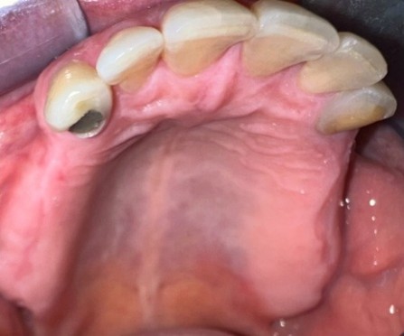 Overcoming Prosthetic Space Limitation in Removable Partial Dentures with Digitally Fabricated Teeth